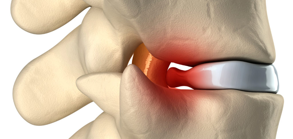 Disc Bulge Treatment at Chirolink Auckland with Dr Mac