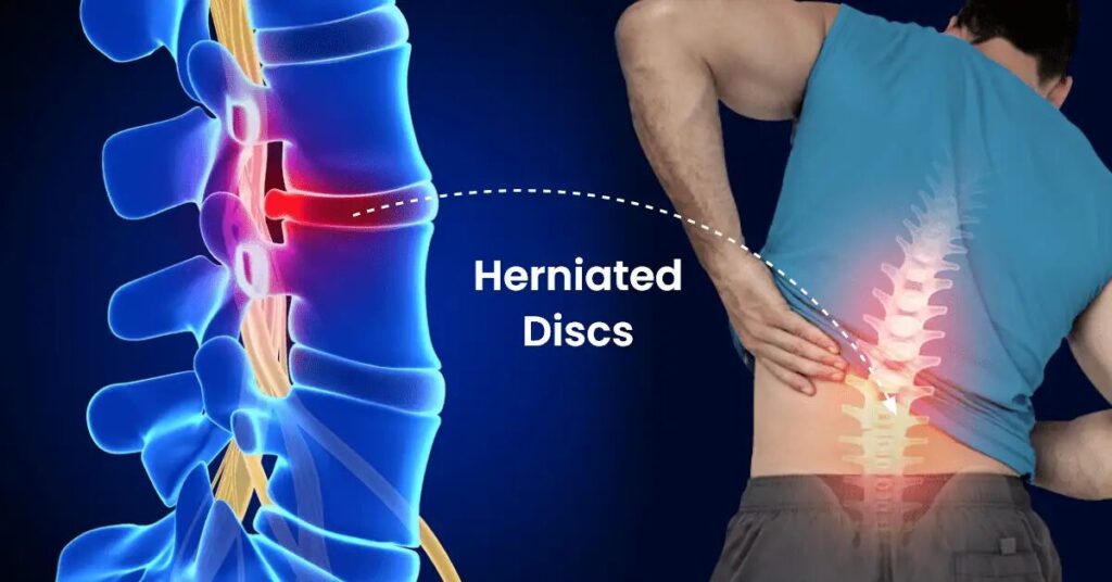 Disc Bulge